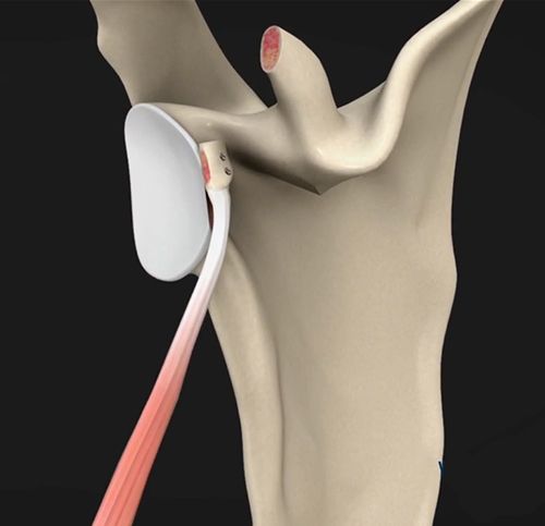 Shoulder Labrum Reconstruction